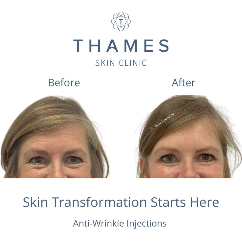 Anti wrinkle injections